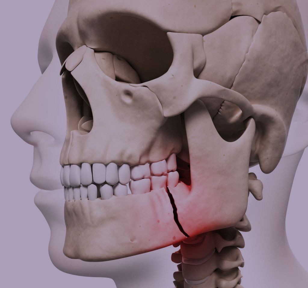 علائم فک شکسته و فک جابه‌جا شده